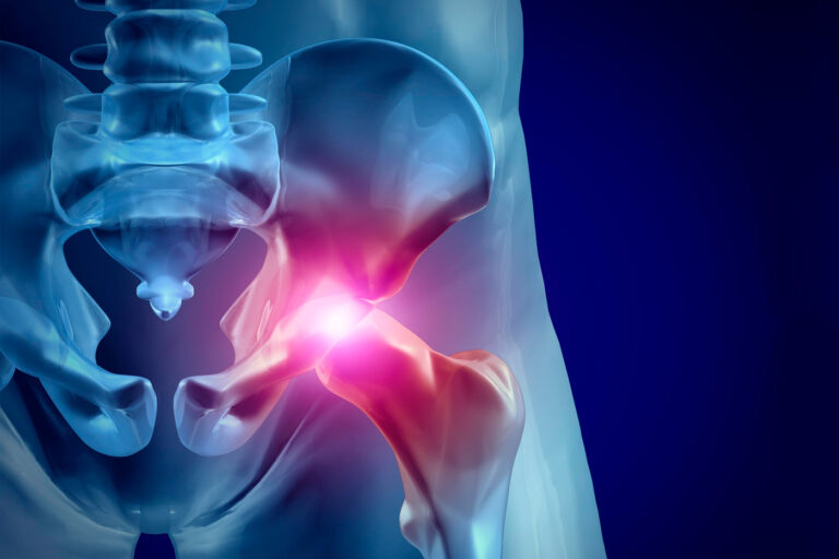 Blog 6 Plantillas para el dolor de cadera