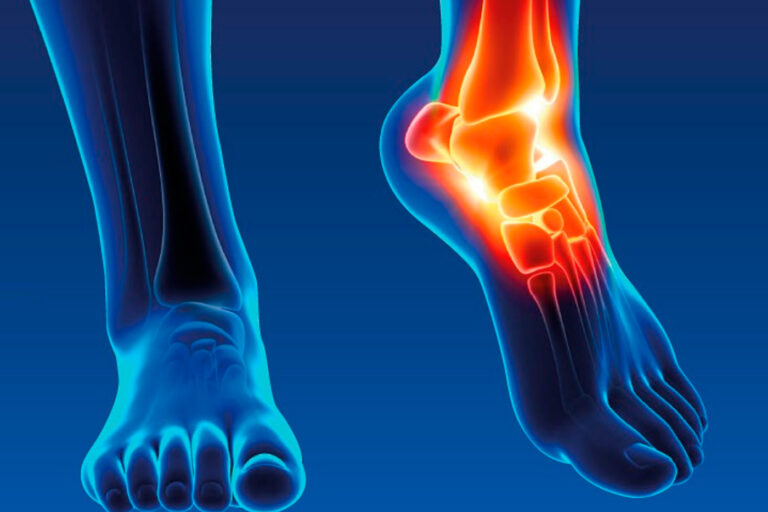 Blog 8 Plantillas a medida para el dolor de tobillo