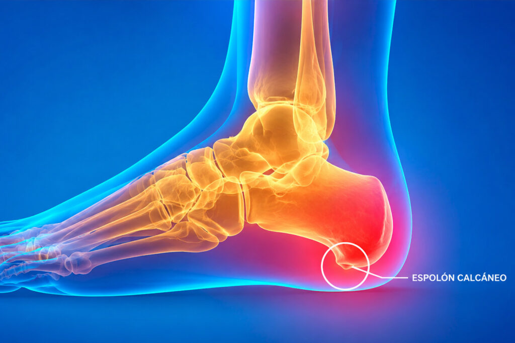 Plantillas para el espolón calcáneo y fascitis plantar